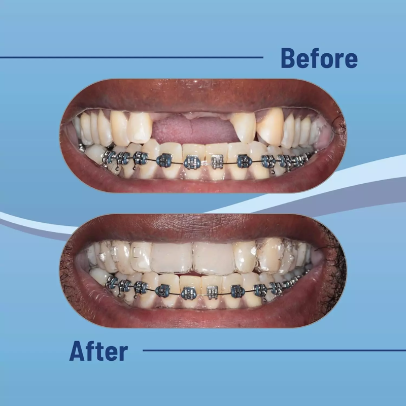 Aligner Pontics Before After