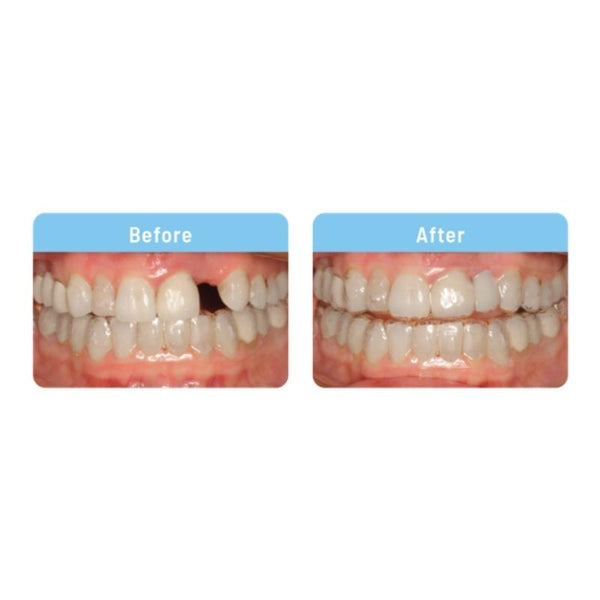 Aligner Pontics Before & After APAC Dental